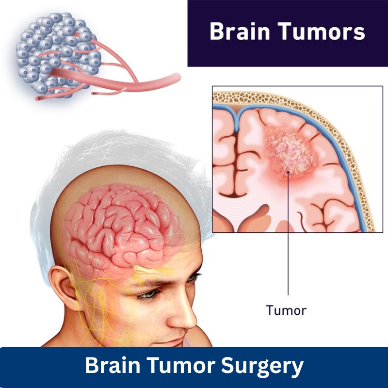 Low Cost Brain Tumor Surgery in India